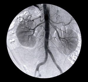 arteriography-391479-m Zánět ledvin