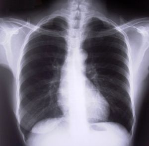 chest-xray-262068-m Plicní chlamydie